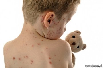 CBD a ovčie kiahne: Môže CBD pomôcť?