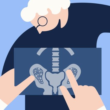 CBD-Öl bei der Behandlung von Osteoporose